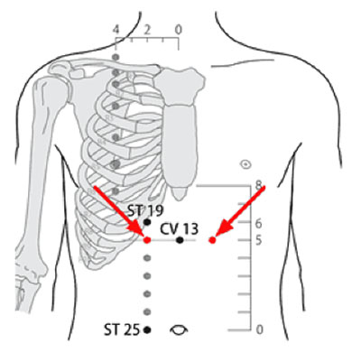 承滿穴→治胃痛、胃痙攣